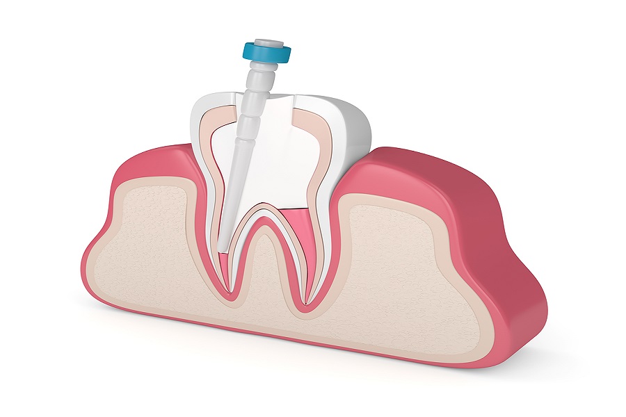 Endodoncia