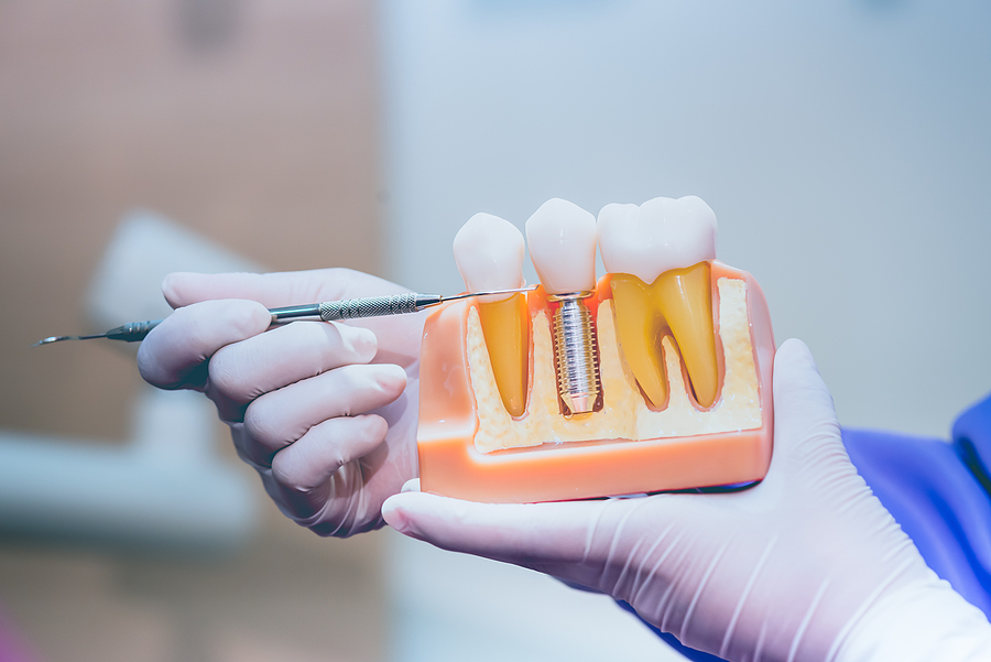 Implantes